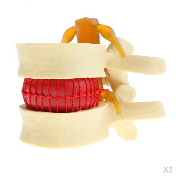 3X Human Spine Lumbar Intervertebral Disc Protrusion Model Magnification 2x