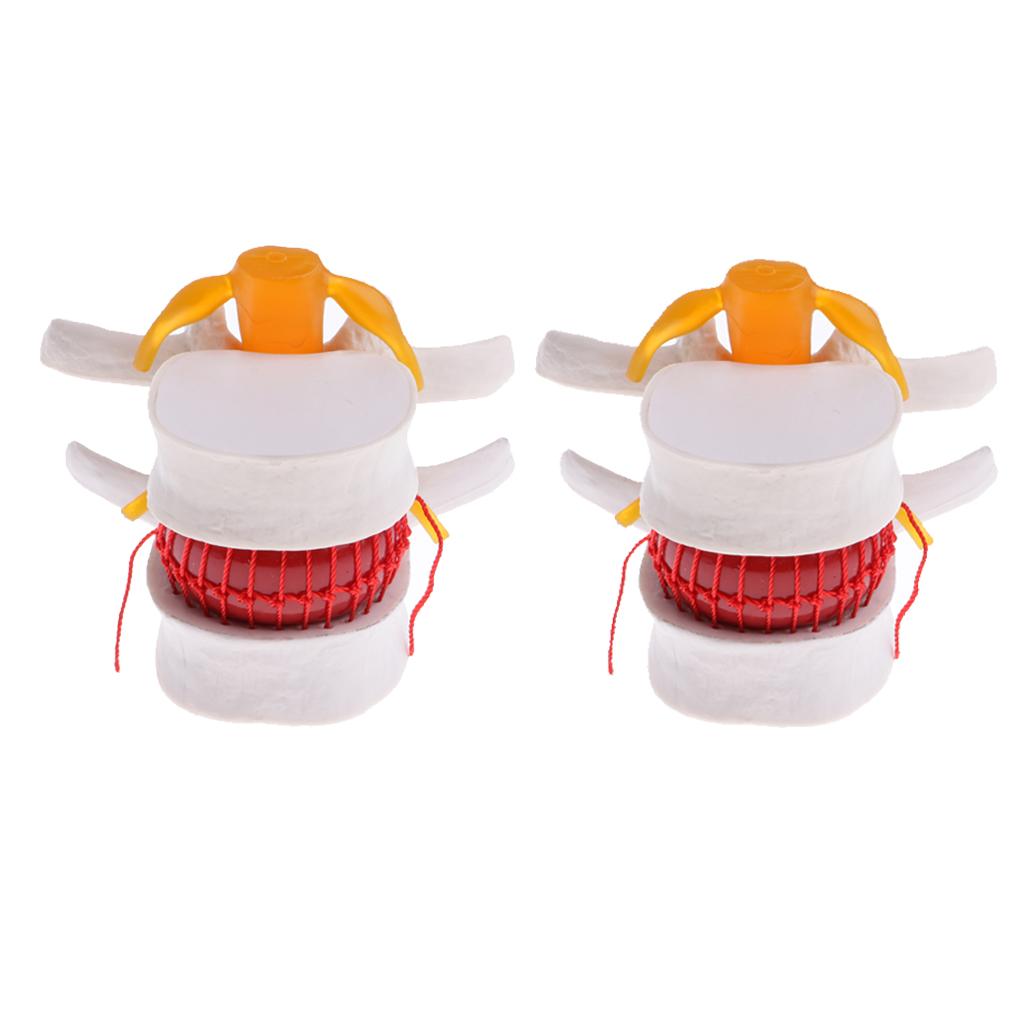 2X Human Spine Lumbar Intervertebral Disc Protrusion Model Magnification 2x