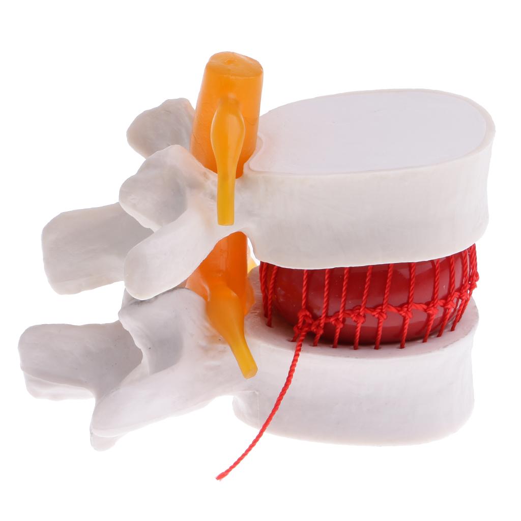 2X Human Spine Lumbar Intervertebral Disc Protrusion Model Magnification 2x
