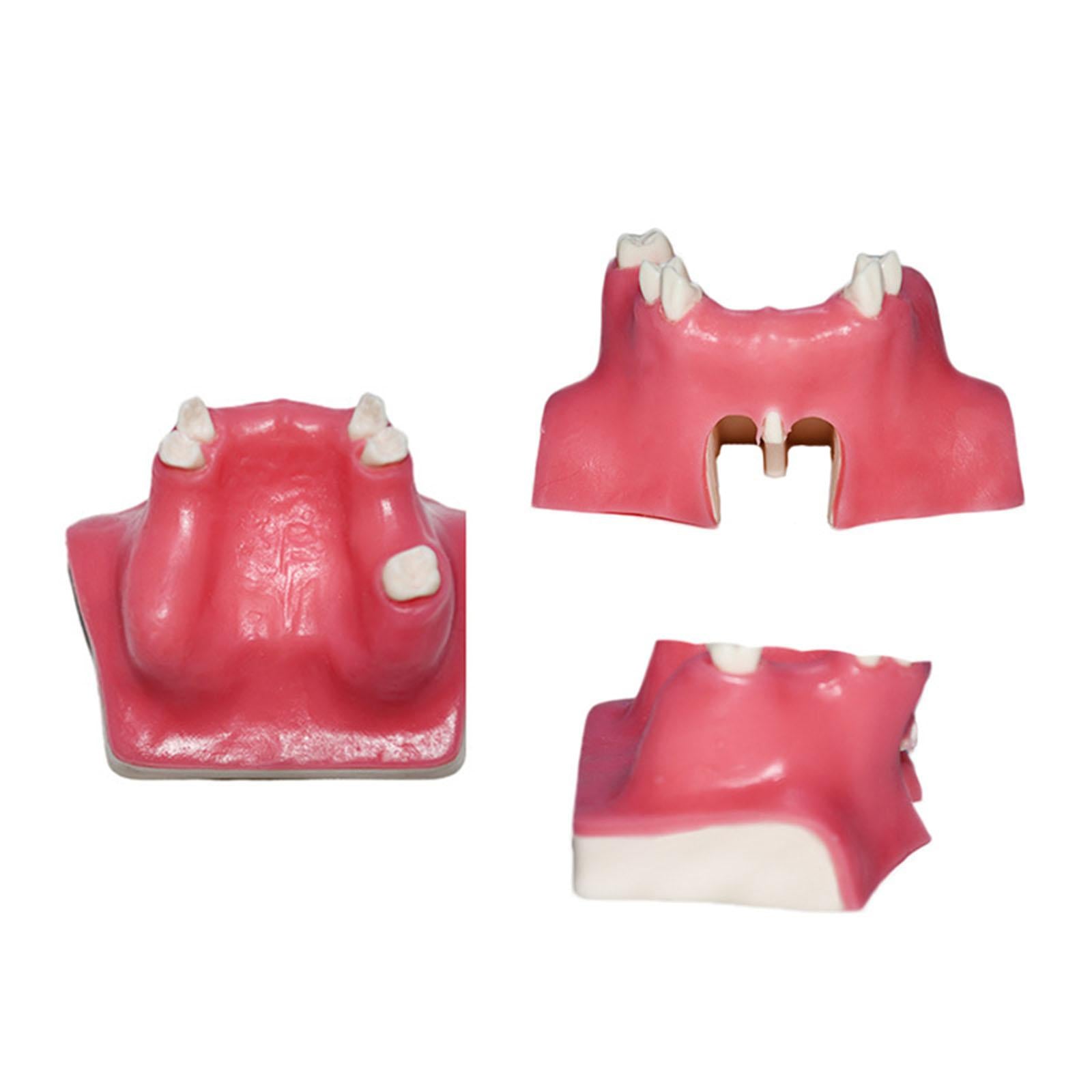 Dental Typodont Implant Tooth Model Medical Training Dental Implant Training