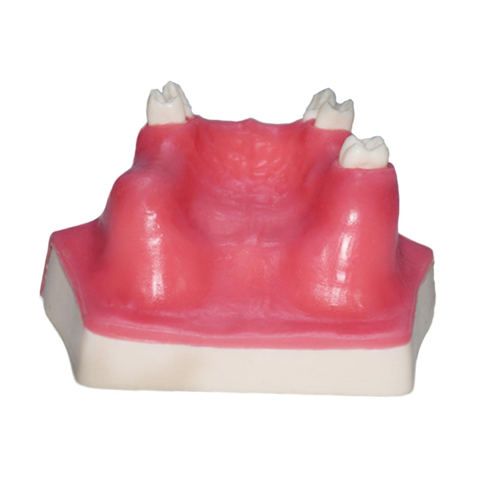 Dental Typodont Implant Tooth Model Medical Training Dental Implant Training