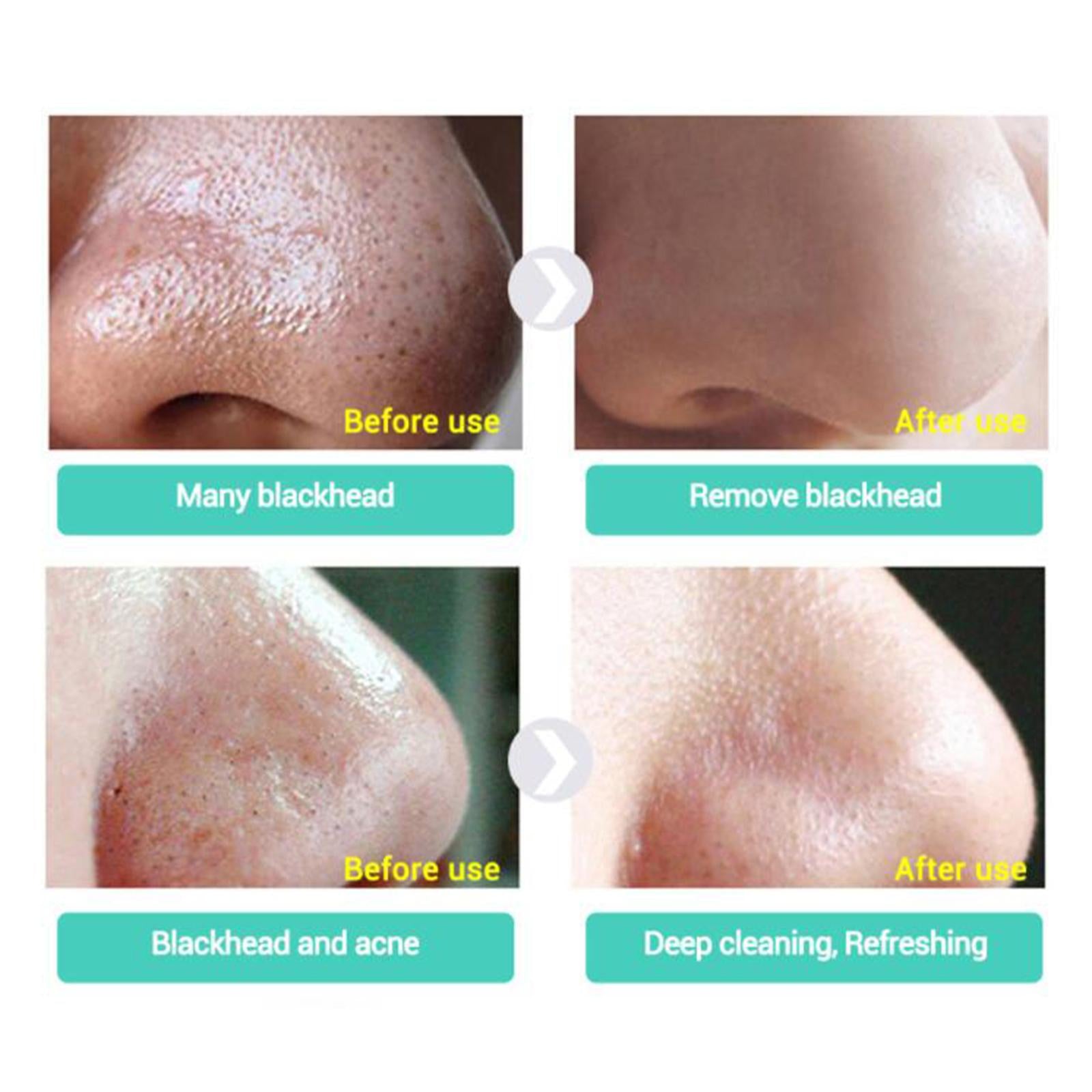 Blackhead Remover Liquid Shrinking Enlarged Pores Blackhead Remover Liquid