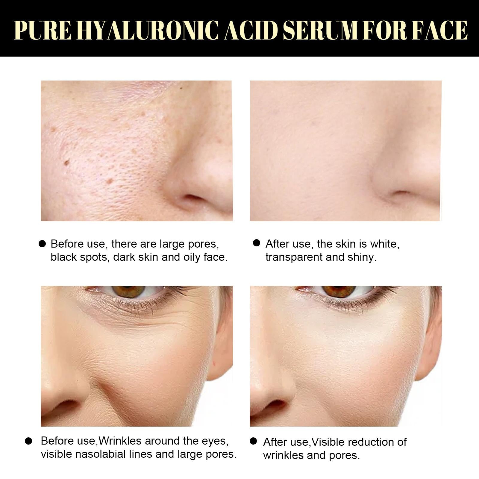 20x Protein Thread Lifting Face Line Carving Reduce Wrinkles Firming Skin