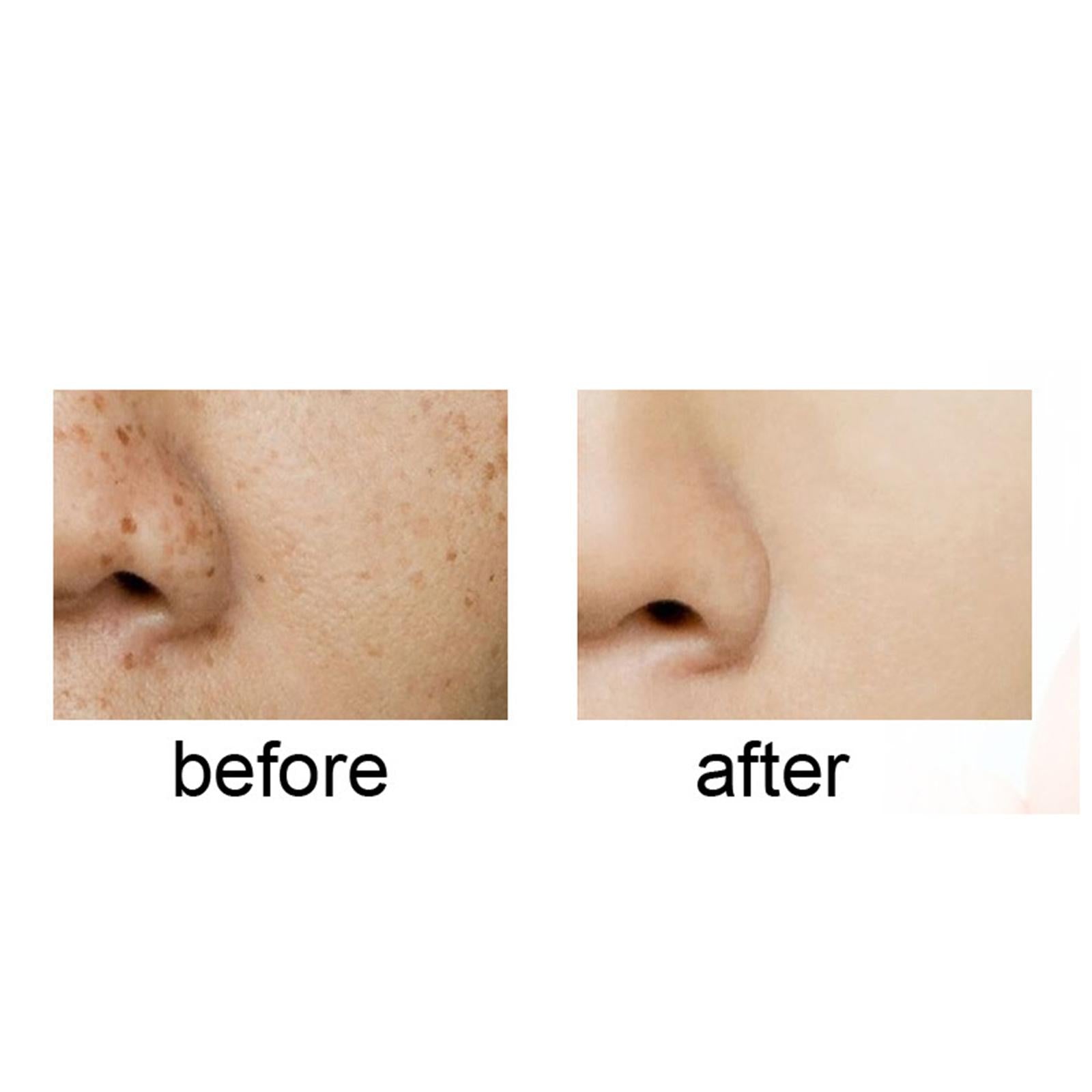 3xFreckle Cream Moisturizer Repair Cream for Melasma Dark Spots Moisturizing