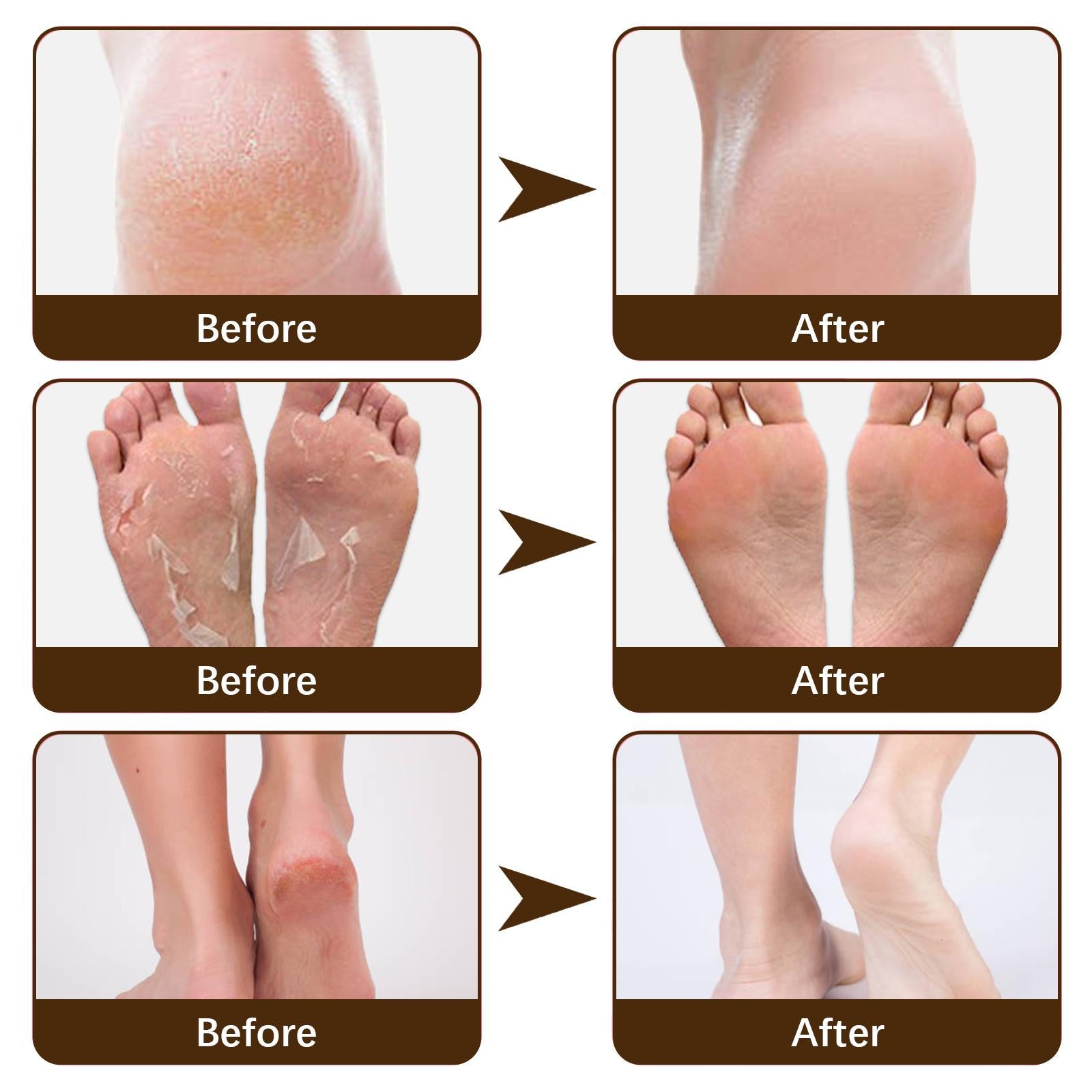 4xCracking Resistance Cream Moisturizing Cracking Feet Hands