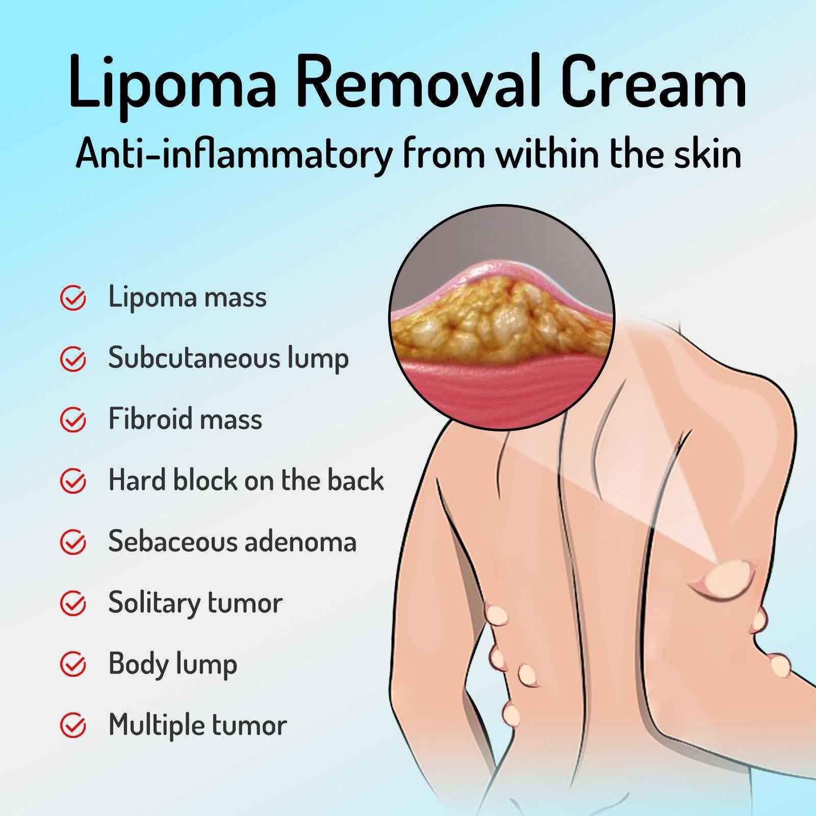 20g Lipoma Removal Cream Mild Easy to Use Care Cream Wide Applaications