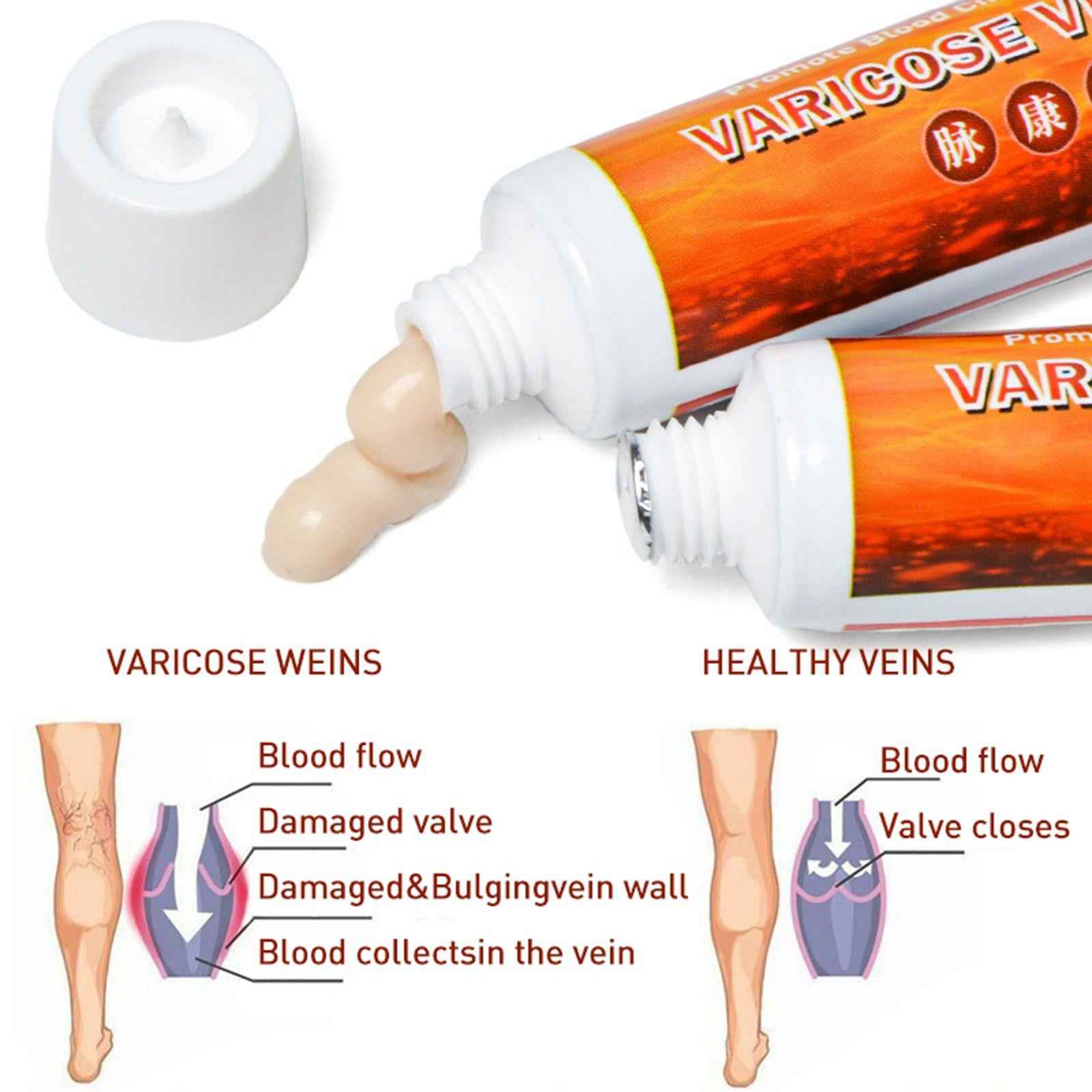 Natural Plant Varicose Veins Treatment Cream Ointment Leg Phlebitis Removal