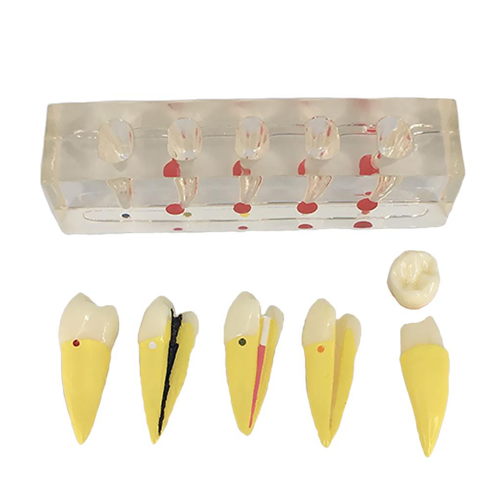 Teeth Pulp Disease Clinical Model for Teeth Teaching Learning