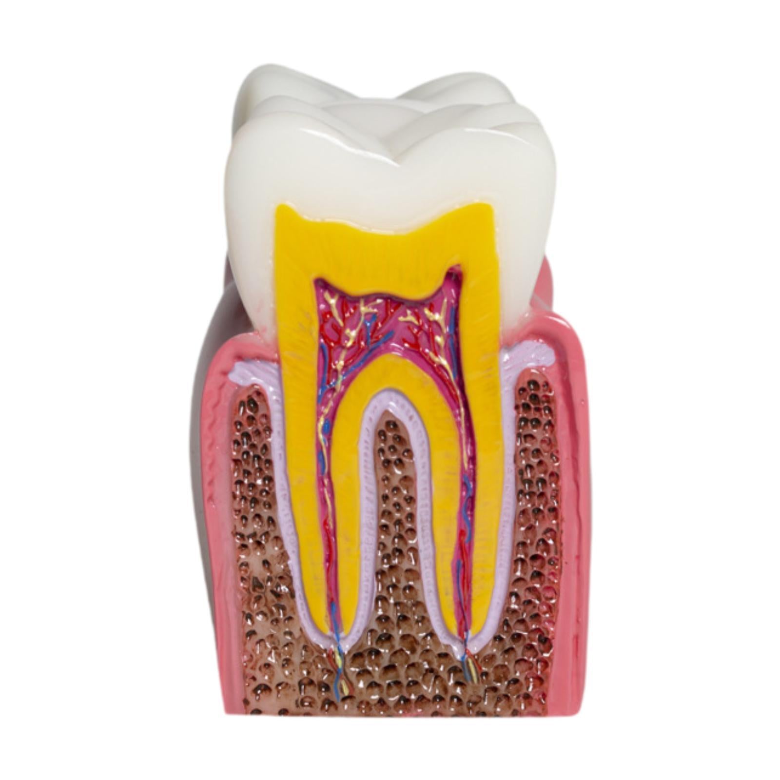 6 Times Caries Tooth Model Teaching Aid for Demonstration Classroom Teachers