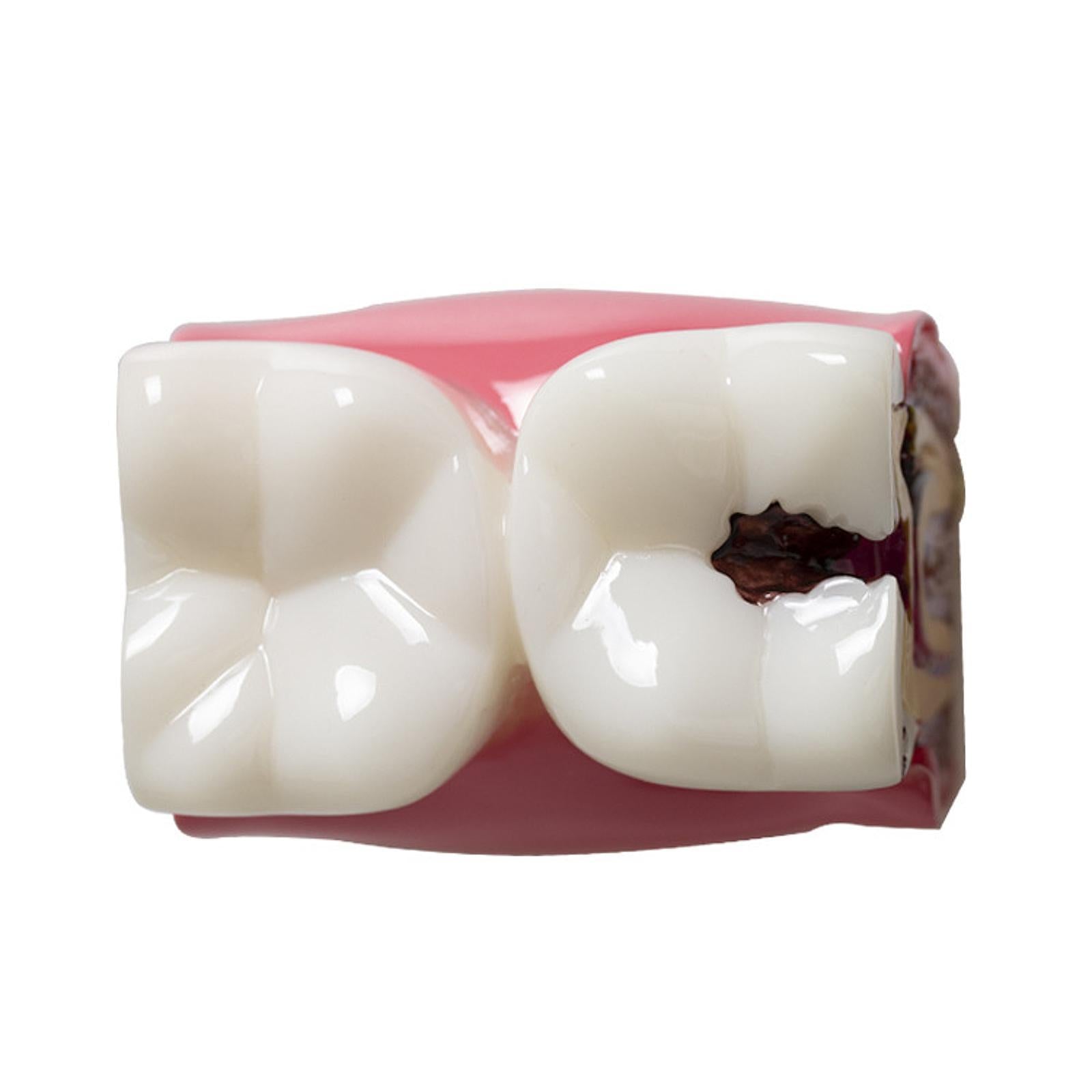 6 Times Caries Tooth Model Teaching Aid for Demonstration Classroom Teachers
