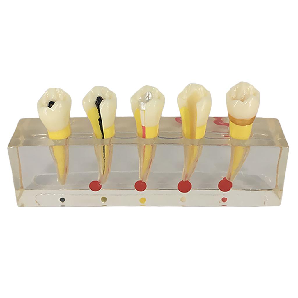 Teeth Pulp Disease Clinical Model for Teeth Teaching Learning