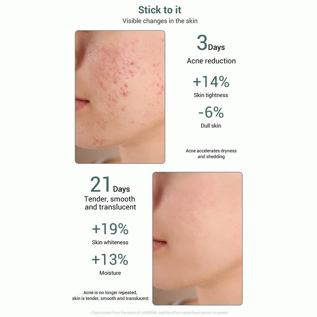 15ml Face Serum Essence Blackhead Removing Repairing Acne Treatment