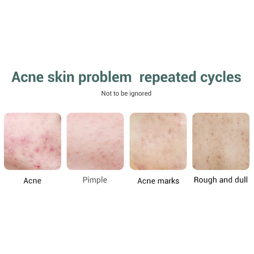 15ml Face Serum Essence Blackhead Removing Repairing Acne Treatment
