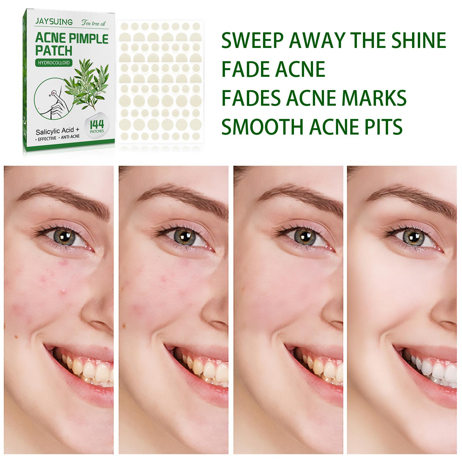 144x Acne Pimple Patches Sweatproof Stickers for Fading Acne Marks Skin Care