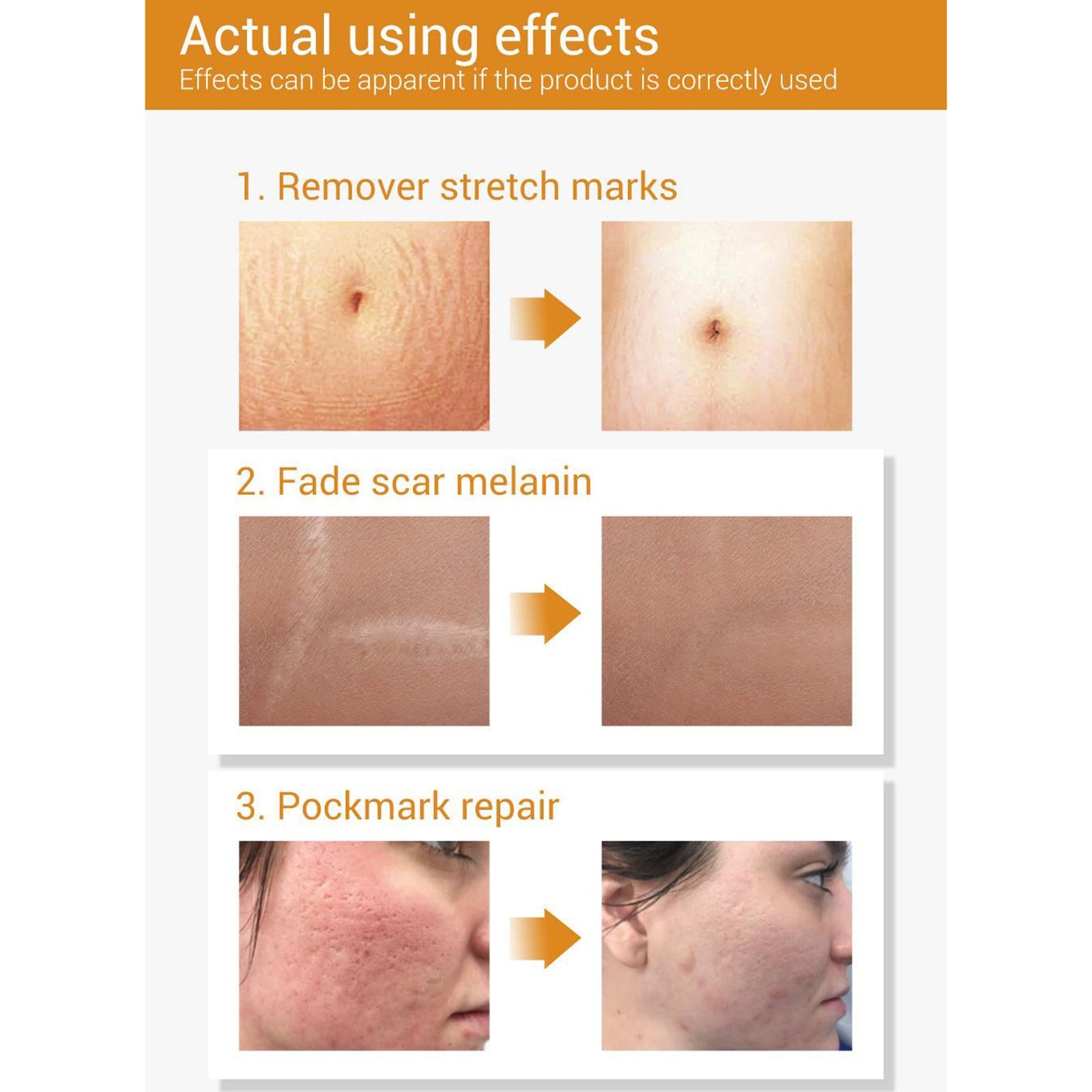 Natural Scar Removal 20ml Acne Pits Removal Essential Oil for All Skin Types