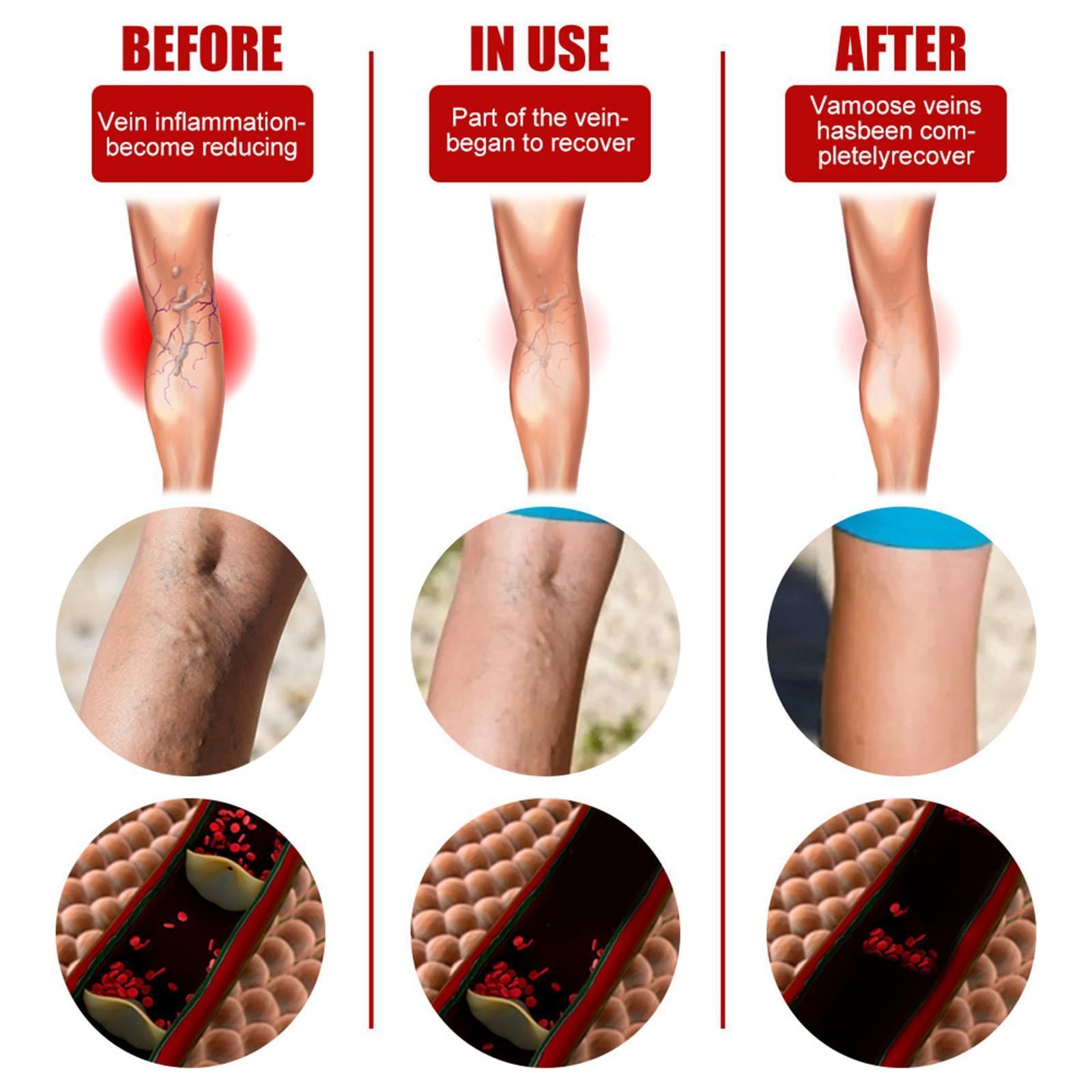 6pcs Vein massage varicose leg vein patch with optional pen with pen