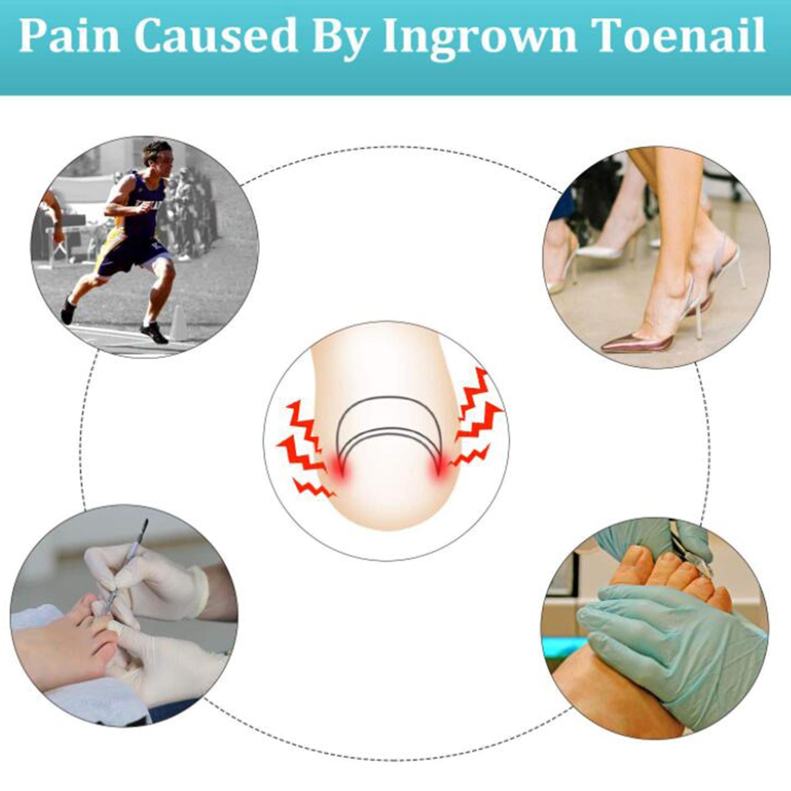 Ingrown Toenail Tool Set Stainless Steel for Cleaning Ingrown Toenails