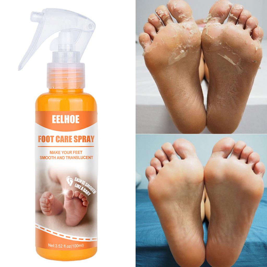 Foot Peeling Spray Feet Hard Skin Remover Hydrating Moisturzing 100ml