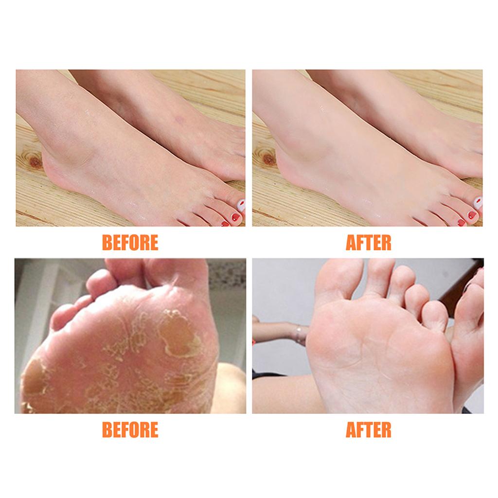 Foot Peeling Spray Feet Hard Skin Remover Hydrating Moisturzing 100ml