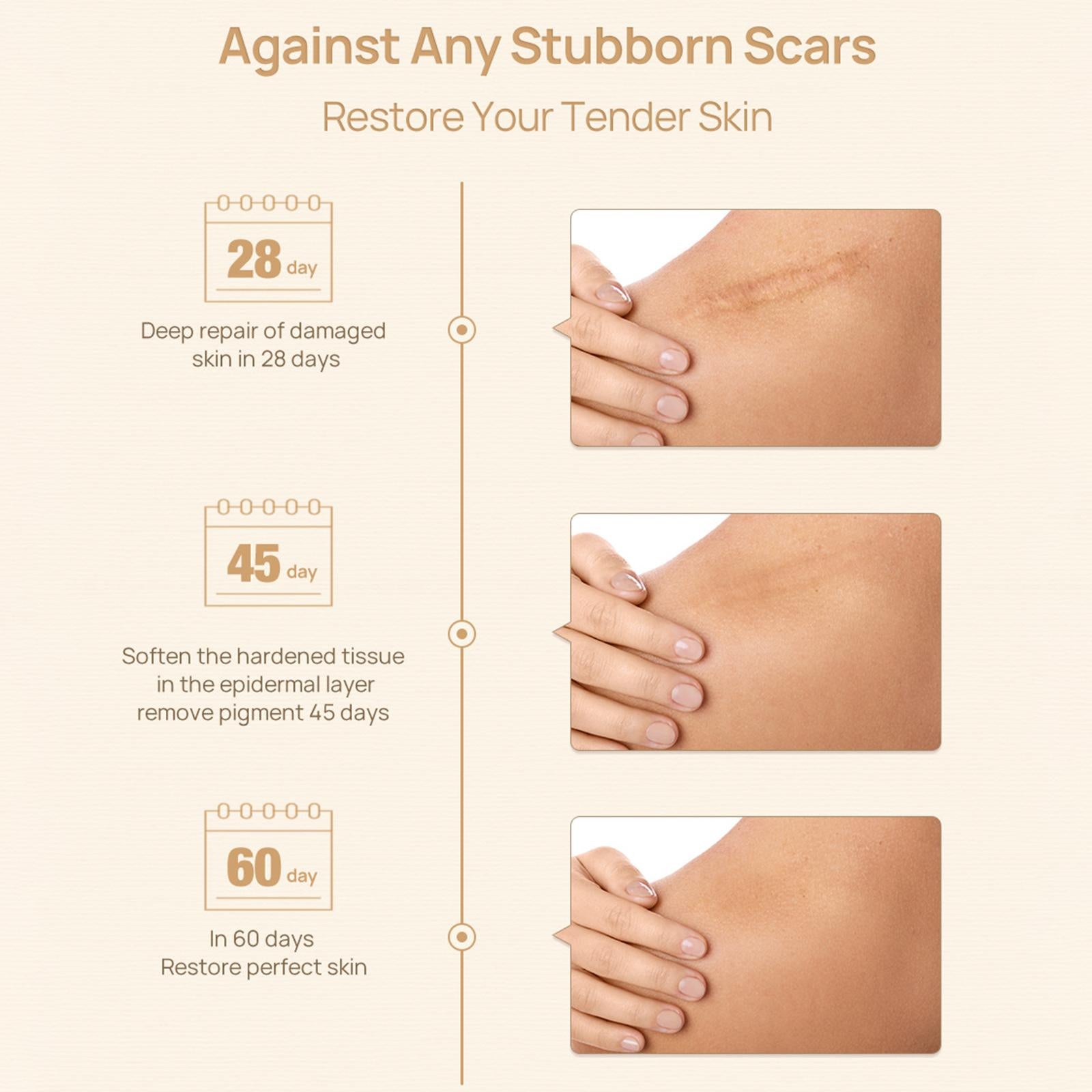 40G Scar and Acne Stretch Mark Removal Cream Face Skin Repair Cream Easy Use
