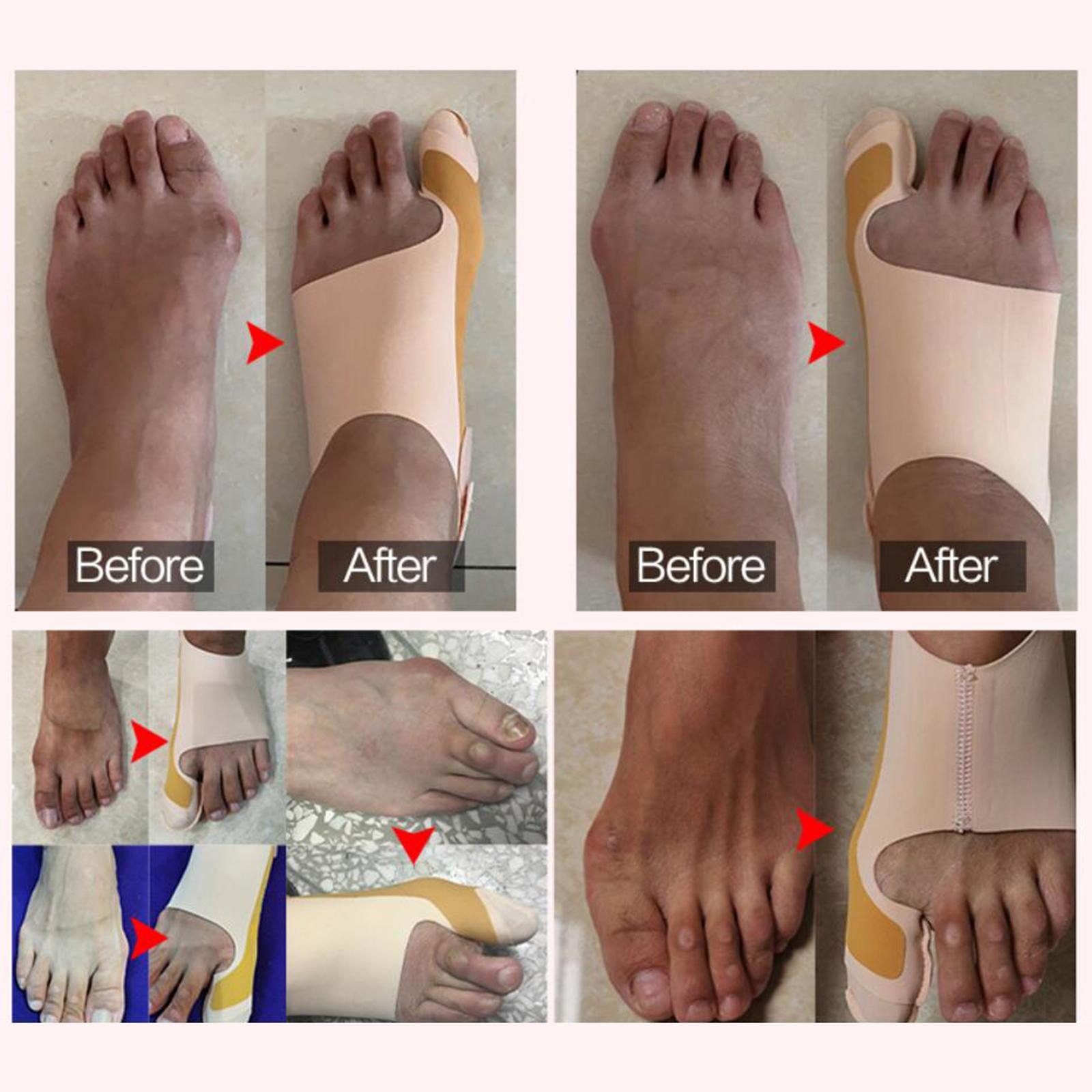Thumb Bunion Orthopedic Corrector Correction Belt Bunion Corrector L Right