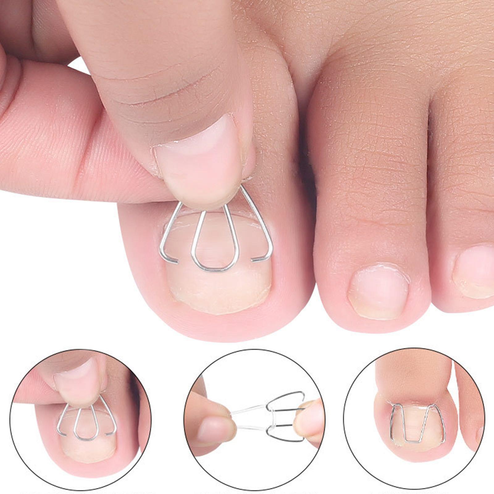 6Pcs Ingrown Toe Nail Correction Wire with 30 Rubber Rings for Women Man