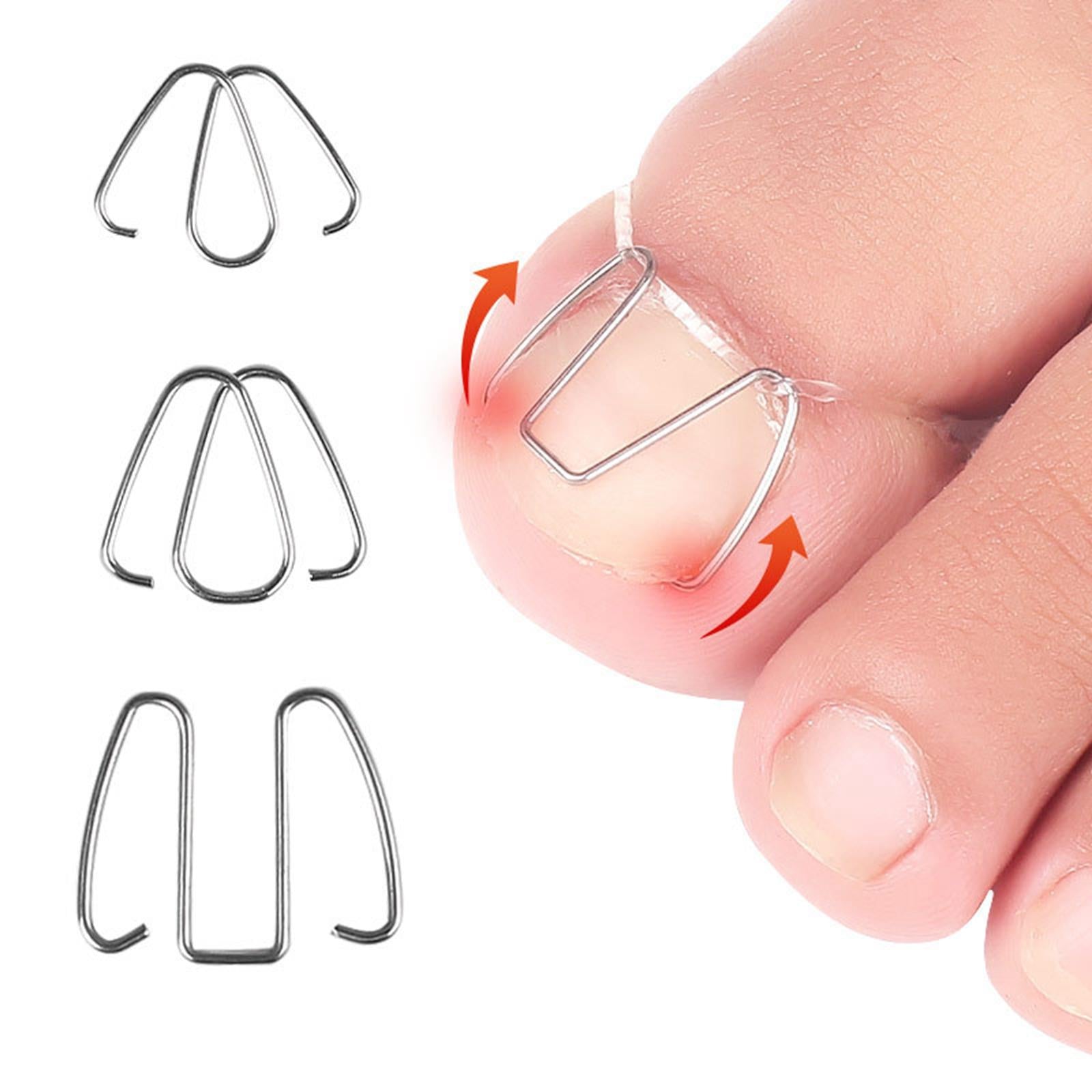 6Pcs Ingrown Toe Nail Correction Wire with 30 Rubber Rings for Women Man