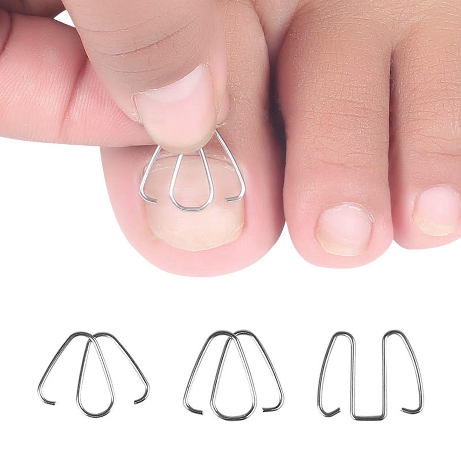 6Pcs Ingrown Toe Nail Correction Wire with 30 Rubber Rings for Women Man