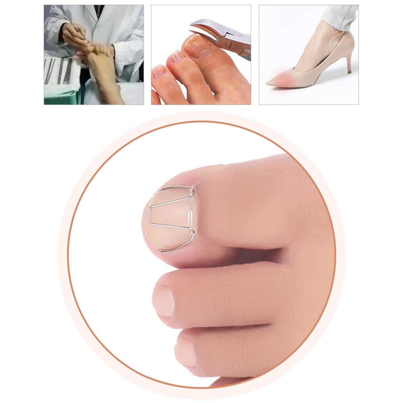 6Pcs Ingrown Toe Nail Correction Wire with 30 Rubber Rings for Women Man