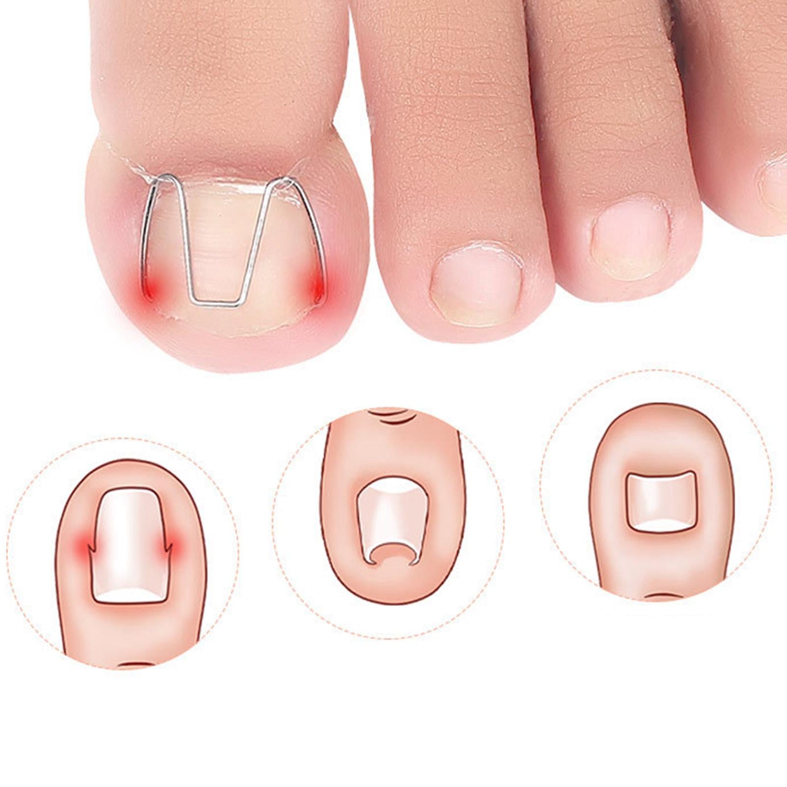 6Pcs Ingrown Toe Nail Correction Wire with 30 Rubber Rings for Women Man