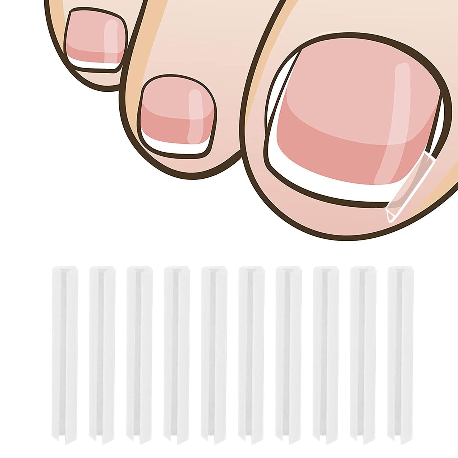Ingrown Toenail Corrector Strips Curved Toenail Corrector Foot Care