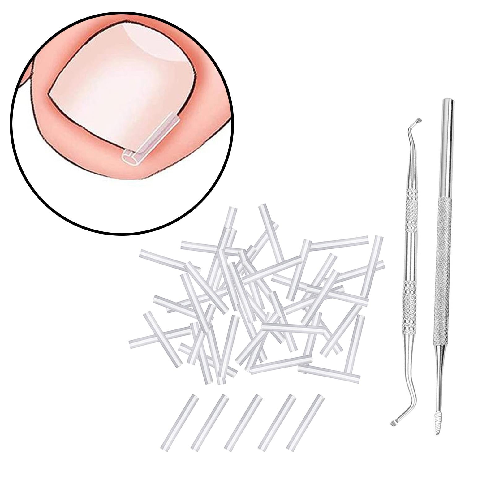 50 Pieces Ingrown Toenail Corrector Strips Nail Groove Pad Lifter Men