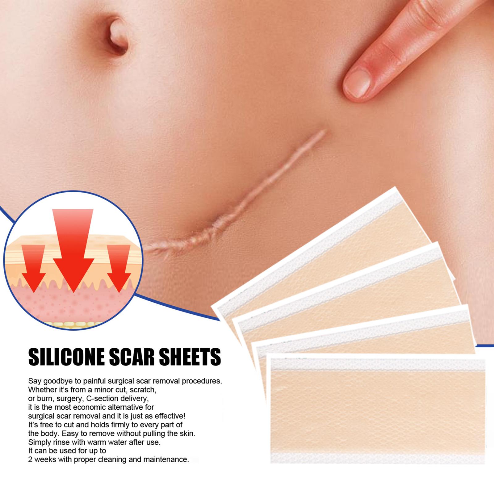 4x Silicone Scar Sheets Strips for Tummy Tuck C Section New and Old Scars 4x7.5cm