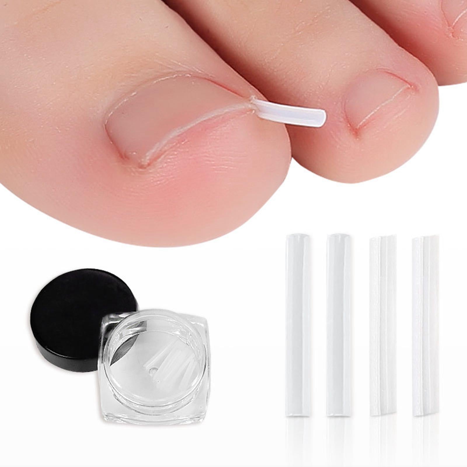 Ingrown Toenail Corrector Stickers Toenail Patch for Foot Care Sticker
