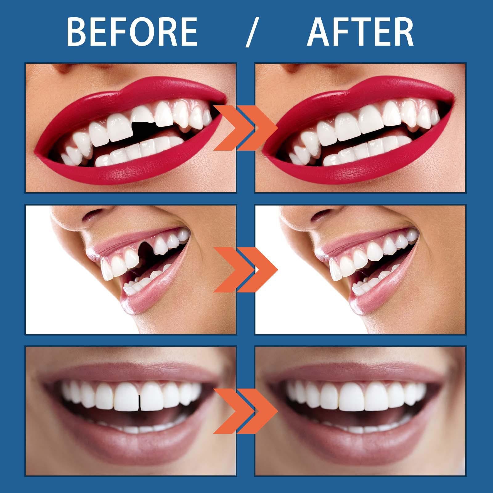25G Temporary Tooth Repair Kit Teeth Gaps Falseteeth for Teeth Veneer Broken