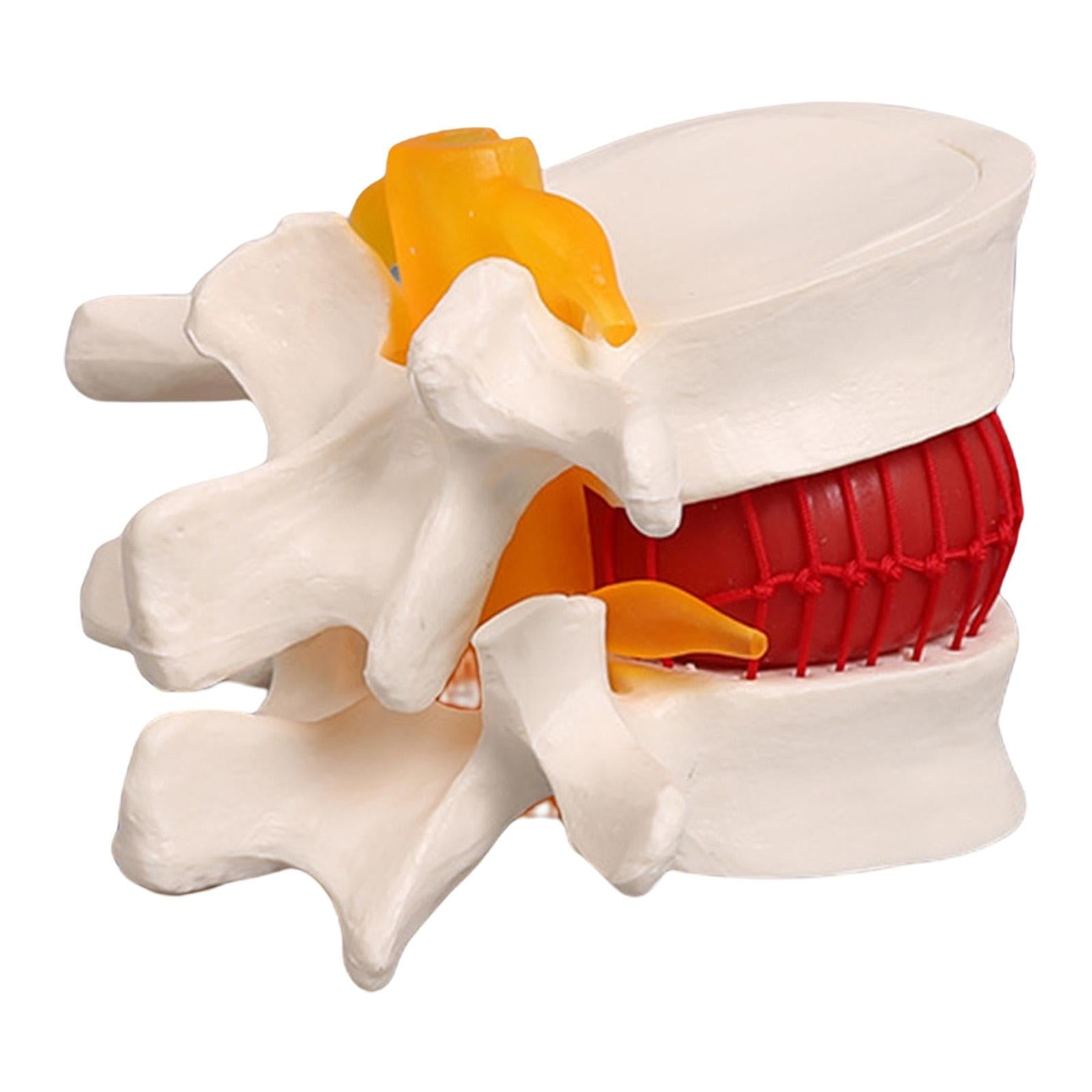 Lumbar Disc Herniation Model Lumbar Spine Model for Learning