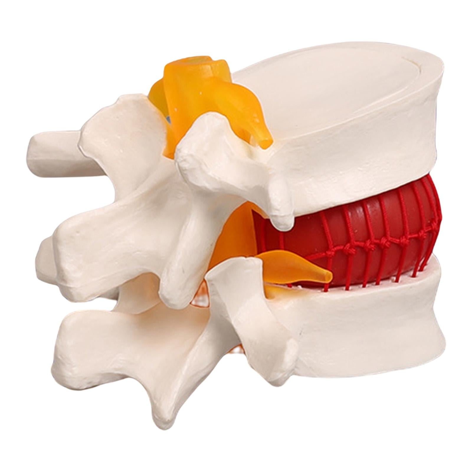 Lumbar Disc Herniation Model Lumbar Spine Model for Learning