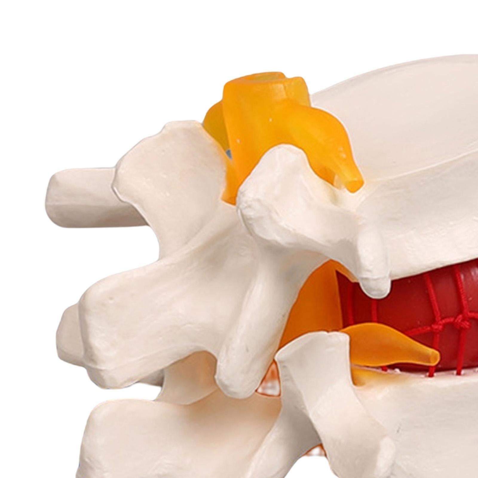 Lumbar Disc Herniation Model Lumbar Spine Model for Learning