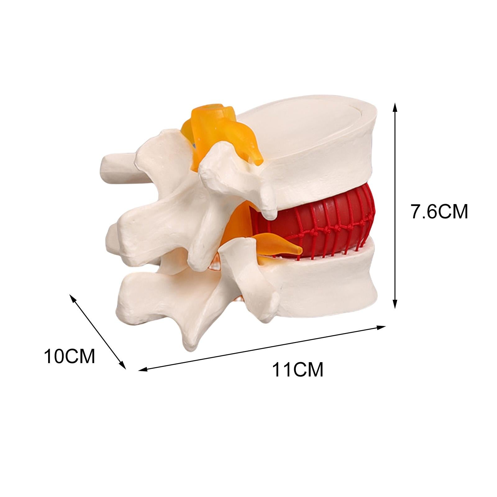 Lumbar Disc Herniation Model Lumbar Spine Model for Learning