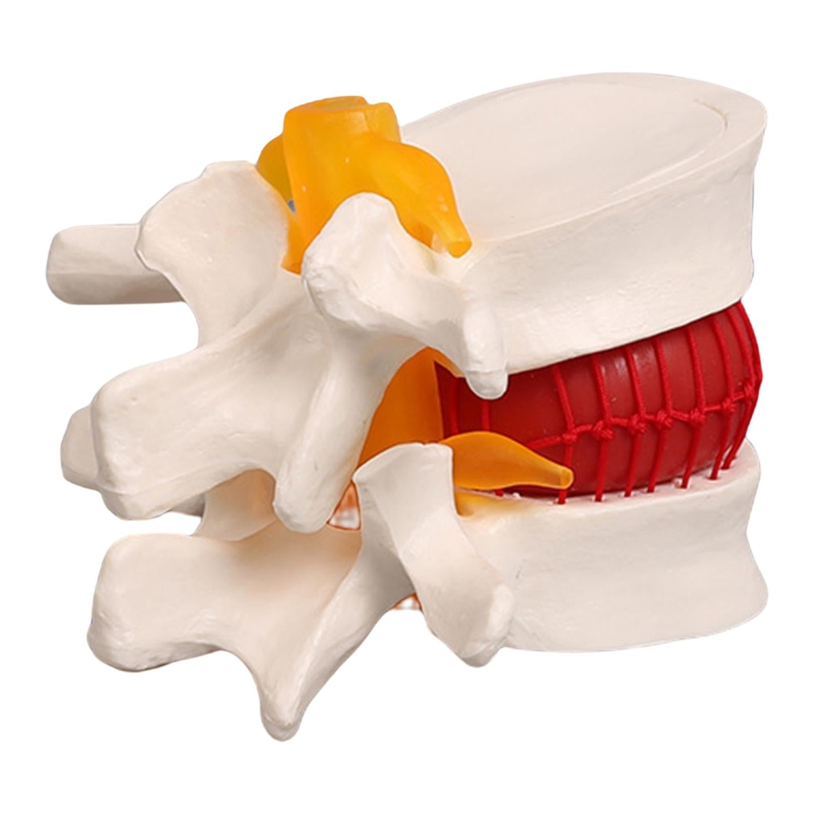 Lumbar Disc Herniation Model Lumbar Spine Model for Learning