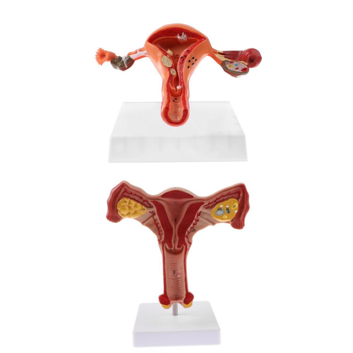 1:1 Human Female Uterus Ovary Pathological +Normal Model Anatomical Study