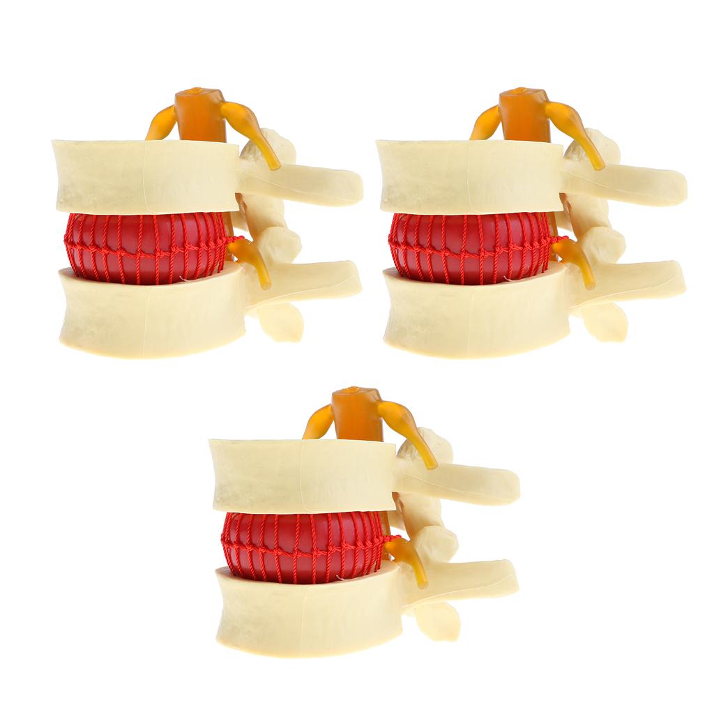 3X Human Spine Lumbar Intervertebral Disc Protrusion Model Magnification 2x