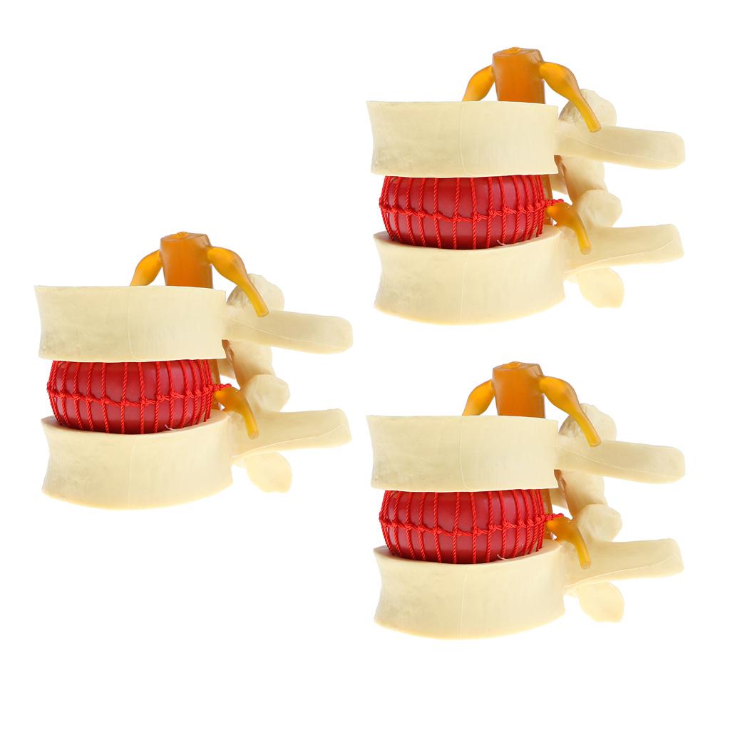3X Human Spine Lumbar Intervertebral Disc Protrusion Model Magnification 2x