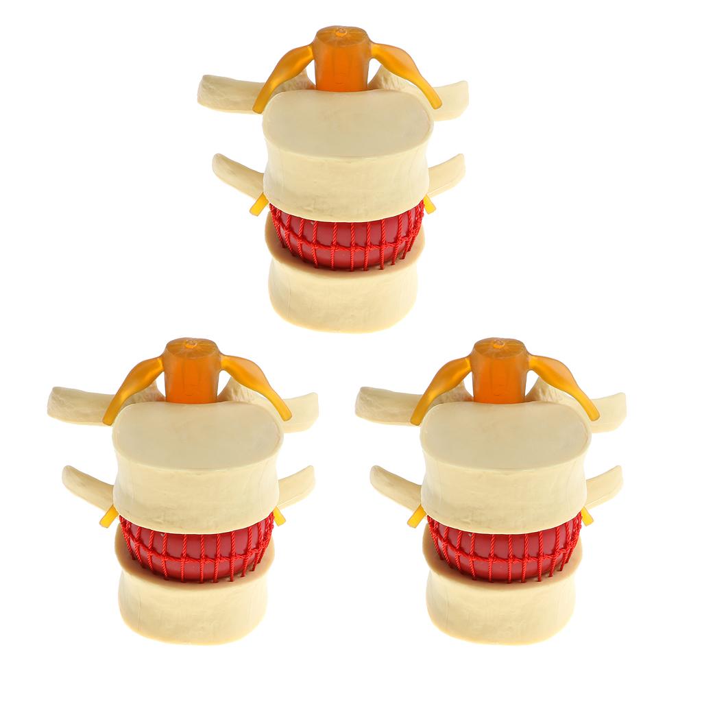 3X Human Spine Lumbar Intervertebral Disc Protrusion Model Magnification 2x