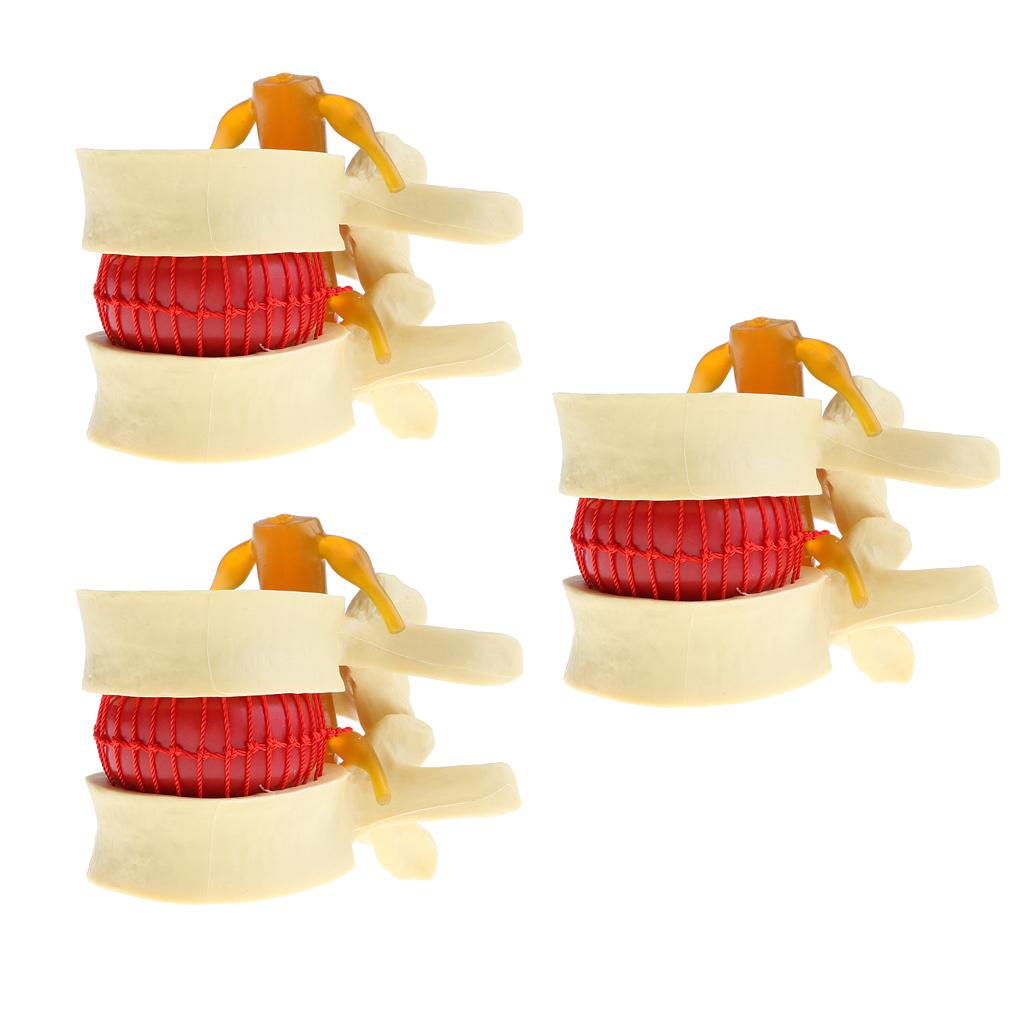 3X Human Spine Lumbar Intervertebral Disc Protrusion Model Magnification 2x