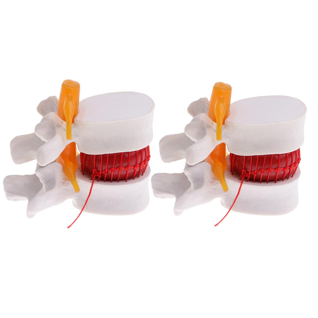 2X Human Spine Lumbar Intervertebral Disc Protrusion Model Magnification 2x