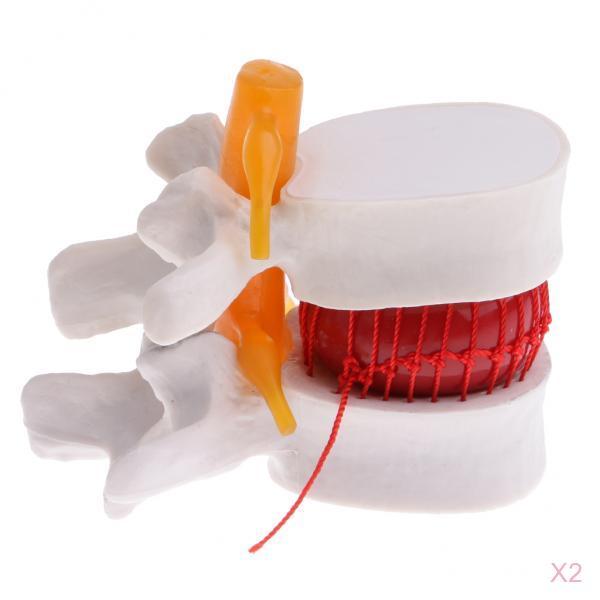 2X Human Spine Lumbar Intervertebral Disc Protrusion Model Magnification 2x