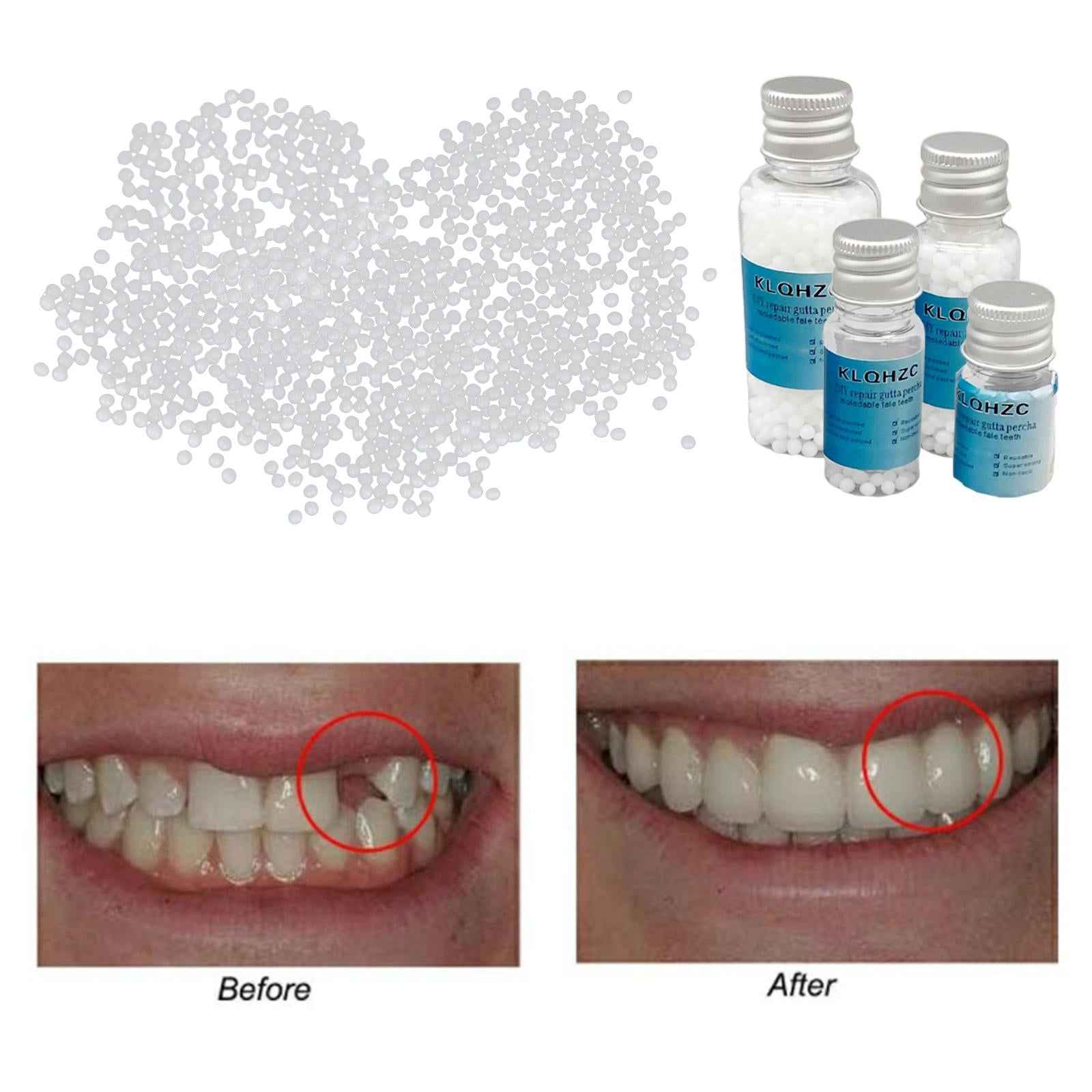 Thermal Beads Teeth Veneer Moldable Denture Temporary Tooth Repair Tool 5g