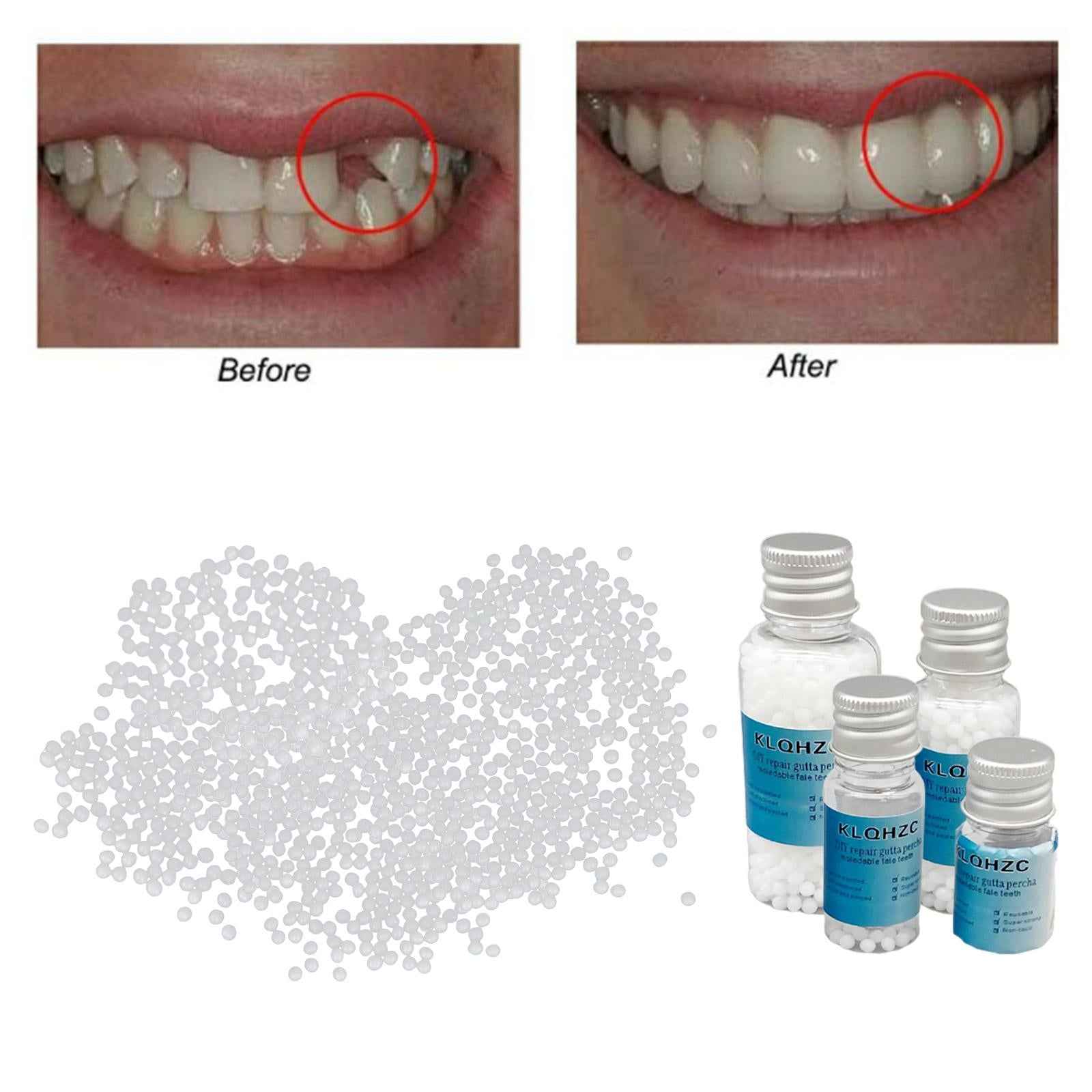 Thermal Beads Teeth Veneer Moldable Denture Temporary Tooth Repair Tool 5g