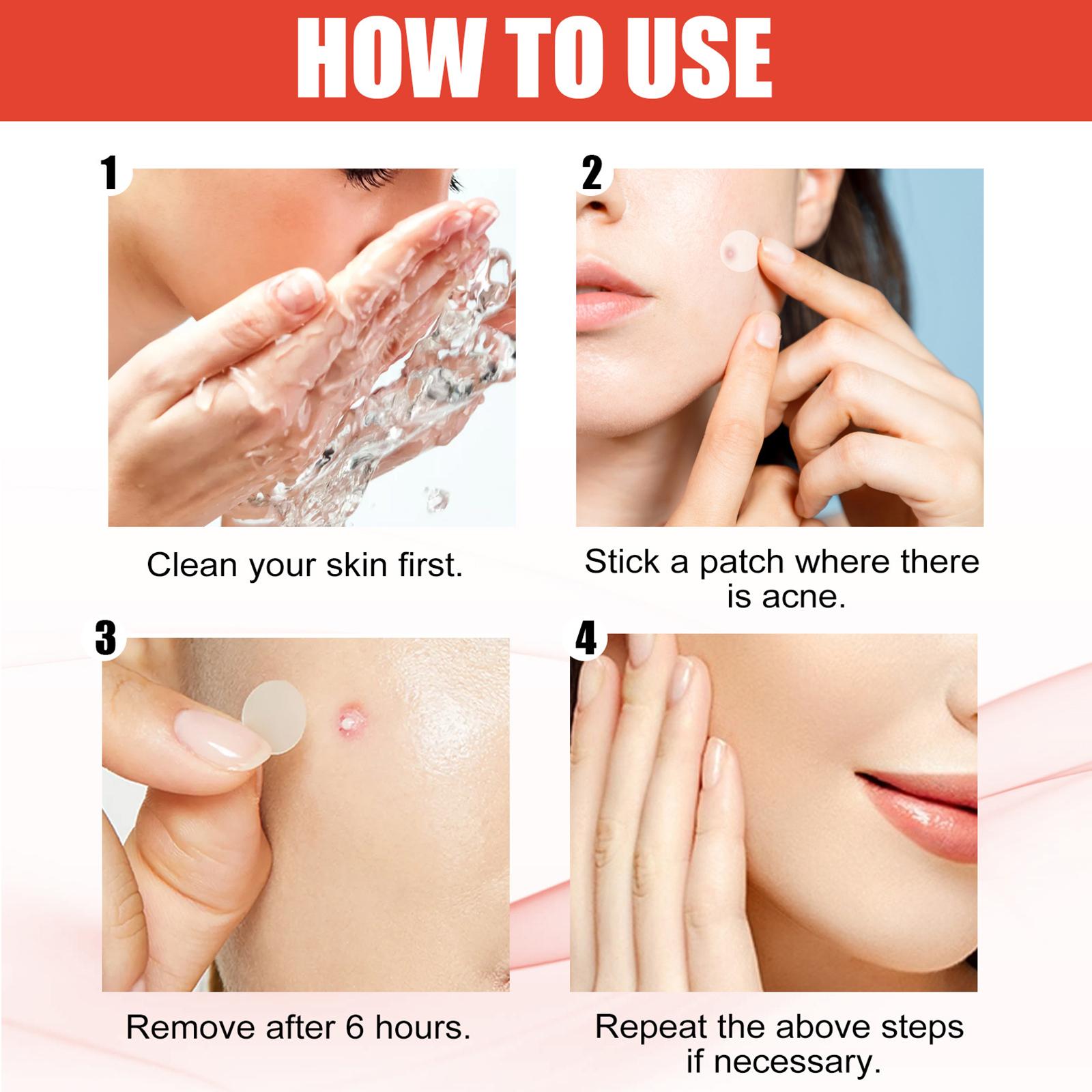3xSet of 144 Hydrocolloid Acne Pimple Patches for Acne Marks Blemishes Zits
